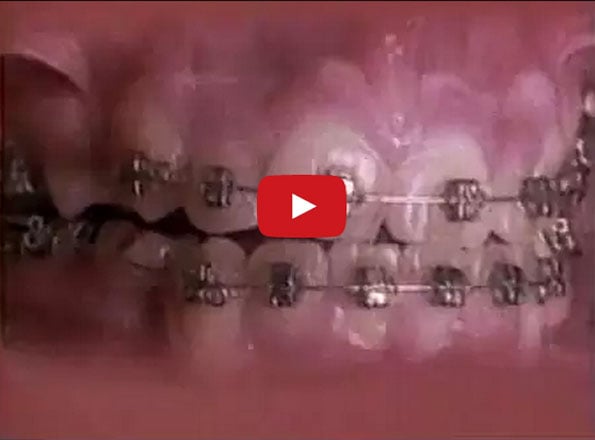A Time-lapse Showing Braces Straightening Out Teeth