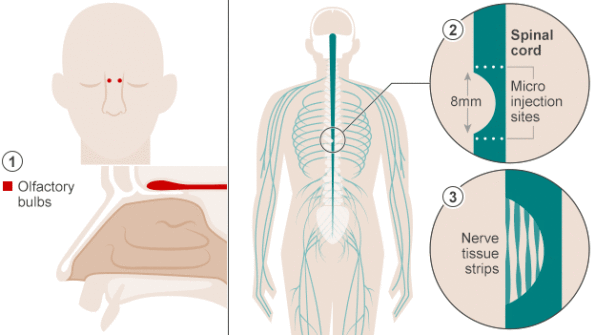 paralyzed-man-walks-again-2