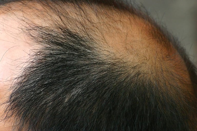 Male pattern hair loss – causes, symptoms and treatment 