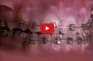 A Time-lapse Showing Braces Straightening Out Teeth