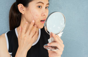 Top 3 Methods To Reduce Acne