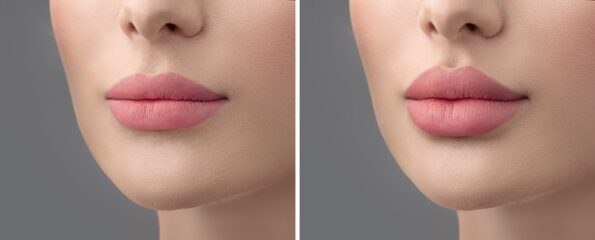 Before and after lip filler injections. Fillers. Lip augmentation Beautiful Perfect Lips. Sexy Mouth close-up. Beauty young woman Lips. Plastic surgery. Close up