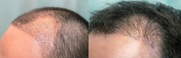 Close up top view of a man's head with hair transplant surgery with a receding hair line. - 1-5 months after Bald head of hair loss treatment.