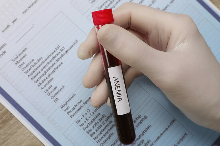 Vitamin Deficiency Anemia, A Quick Guide