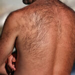 Say Goodbye to Back Hair: How Laser Hair Removal Can Help Men