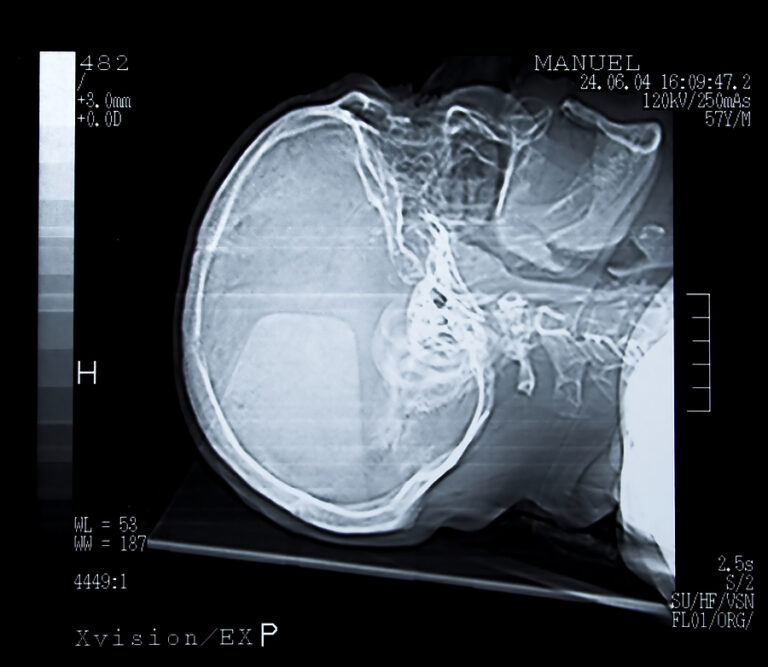 Eggshell Skull Rule: What Is It and How Is It Applied in Personal Injury Claims?